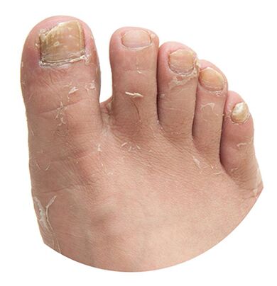 Causes de pieds Fungus