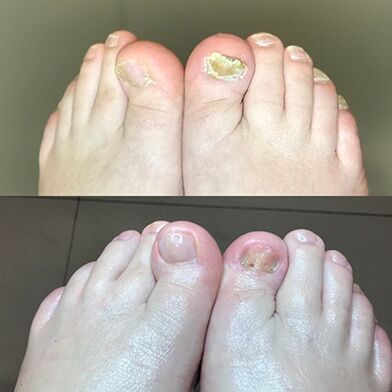 Expérience dans l'utilisation de Barnabas à la crème Israël Promicil, photo avant et après