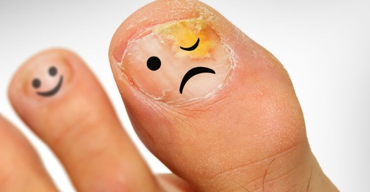 Comment reconnaître les champignons à ongles