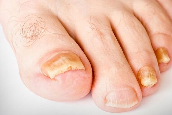 La troisième étape de l'ongle Hirb