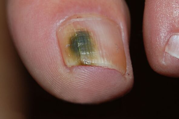 Type mohose de champignons à ongles