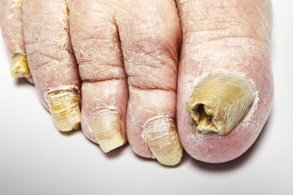 Version des champignons à ongles totaux