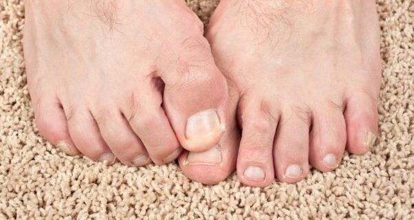 Symptômes de champignon de clou