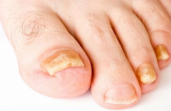 Le champignon sur le pouce