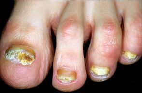 Caractérisation de la maladie