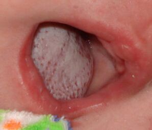 Emplacement de la maladie avec un champignon