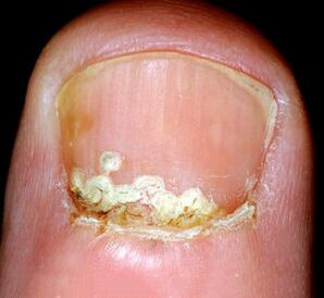 Symptômes et signes de la maladie