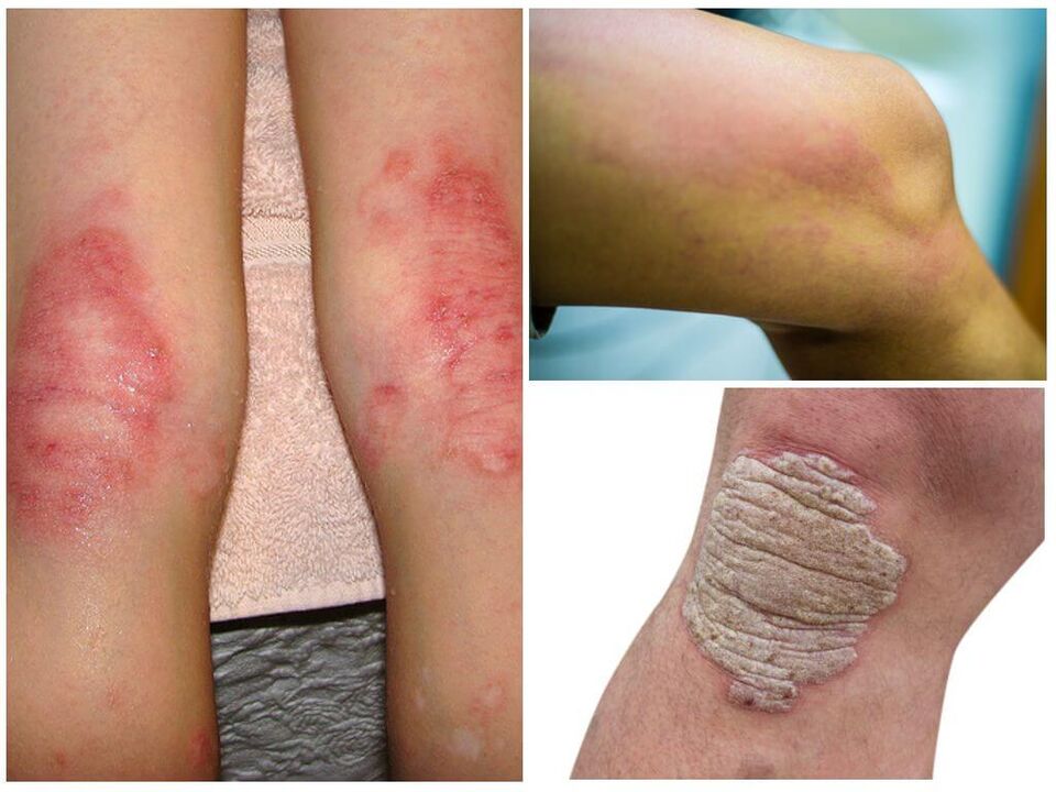 Infections fongiques des genoux.