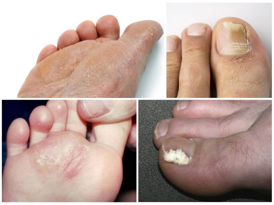 Le stade initial du champignon du pied.