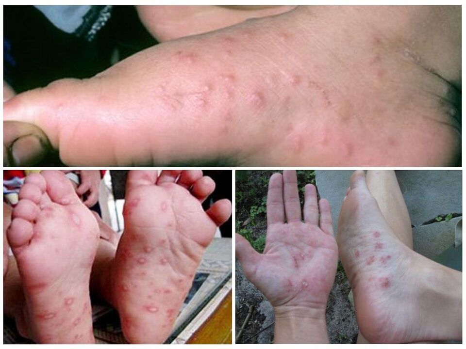 Lésions hyperkératosiques des pieds.