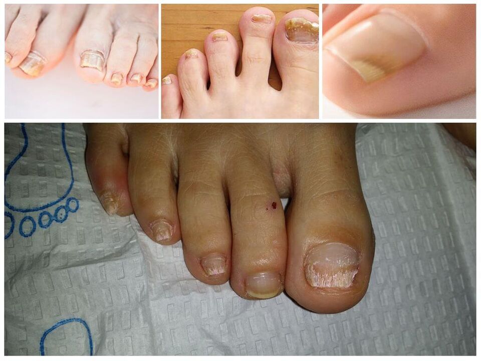 Maladies fongiques des plaques à ongles.