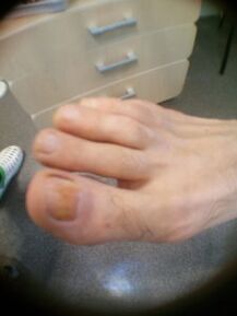 Stade initial de la mycose des ongles du gros orteil.