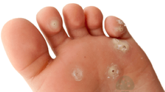 deuxième stade de l'infection fongique