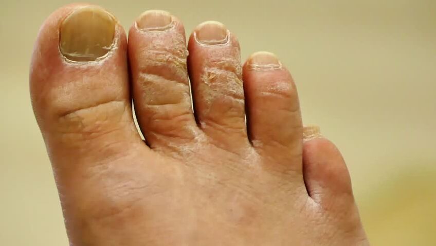 forme squameuse de champignon des ongles des pieds