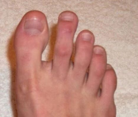 ongles après traitement au laser pour les champignons