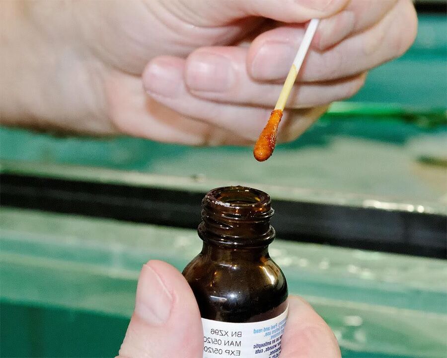 L'application d'un mélange d'iode et de jus de chélidoine sur vos ongles éliminera le champignon.