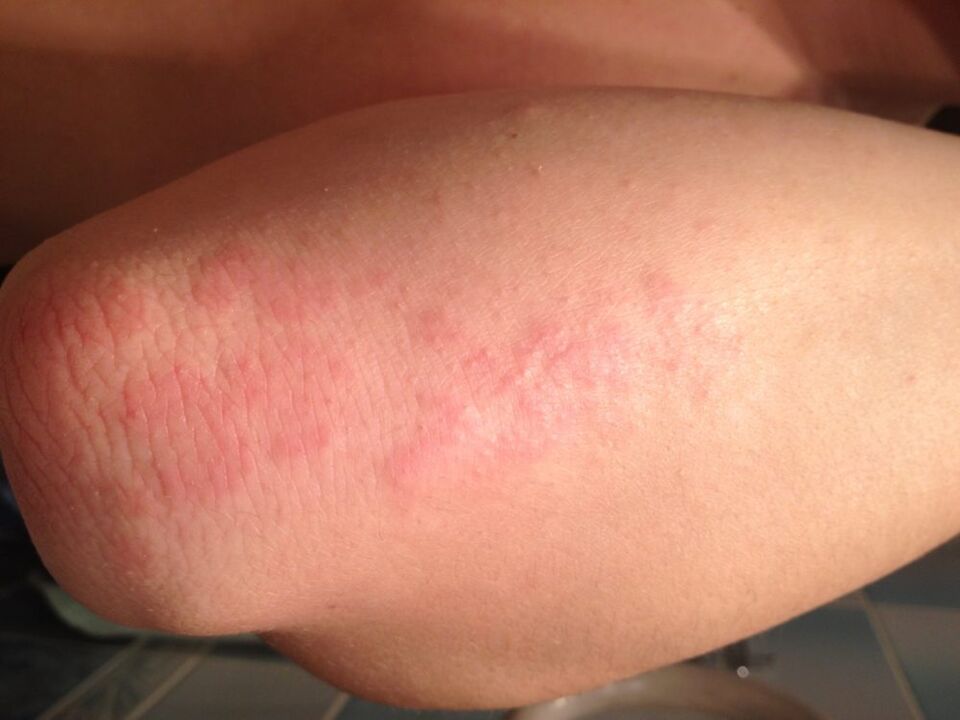 Une réaction allergique sous la forme d'une éruption cutanée sur la peau du coude après l'application d'une goutte de jus de chélidoine.